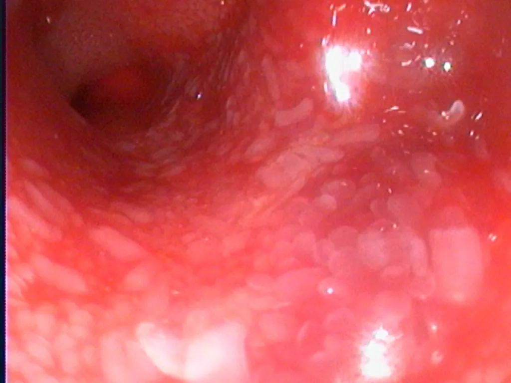 Endoscopic view of colitis during a canine colonoscopy
