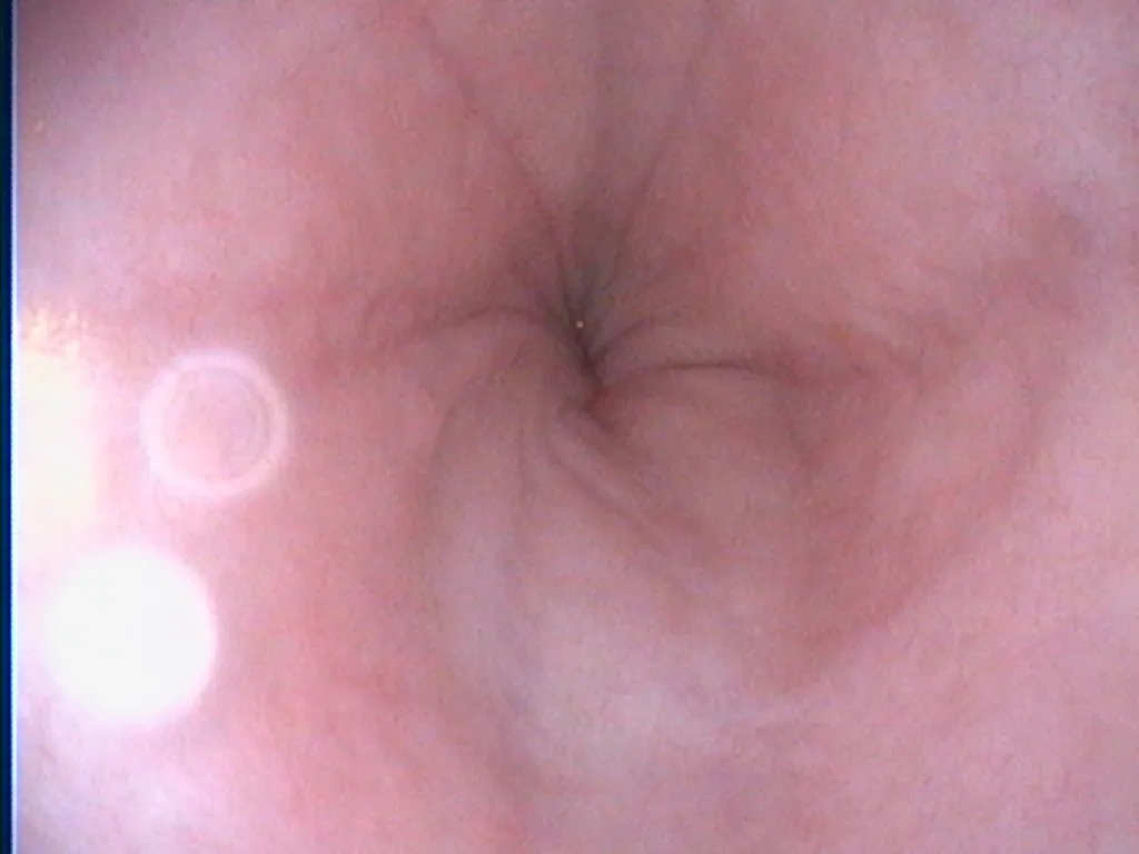 Endoscopic view of the esophagus during a companion animal scope procedure