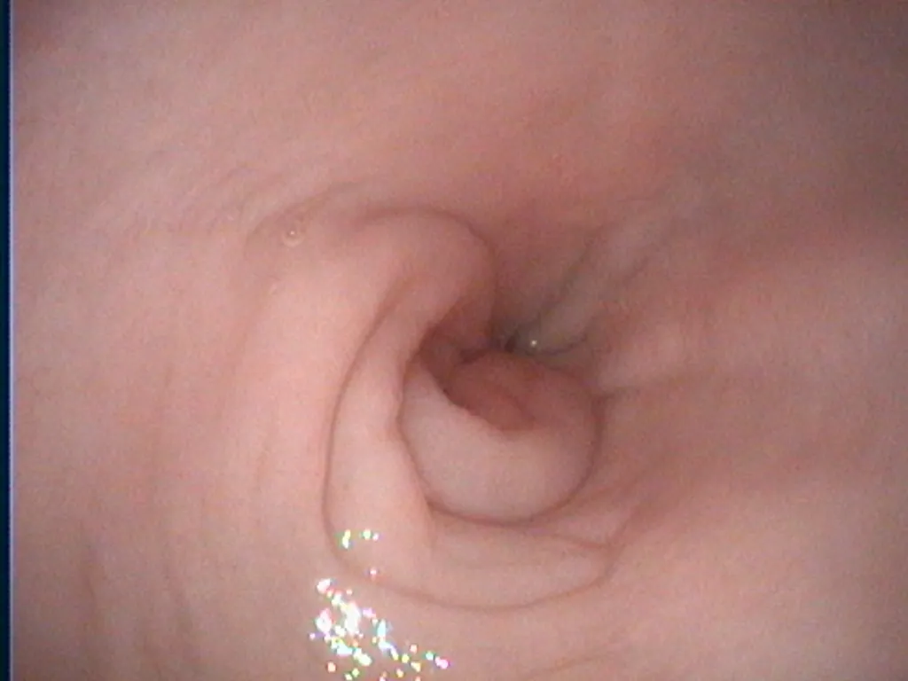 Endoscopic view of a mild hiatal hernia in a dog