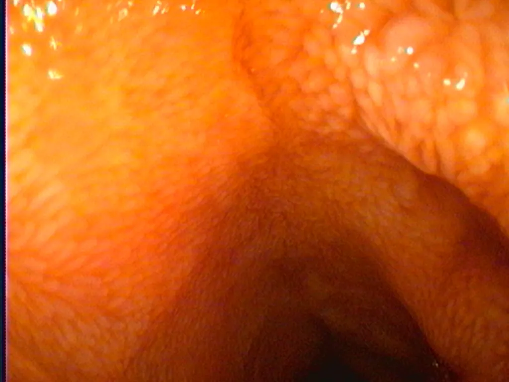 Endoscopic view of small intestine mucosa during diagnostic enteroscopy