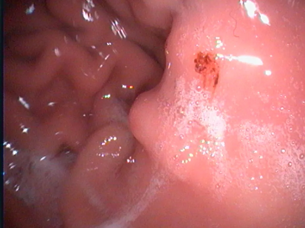 Endoscopic view of a gastric ulcer in a companion animal
