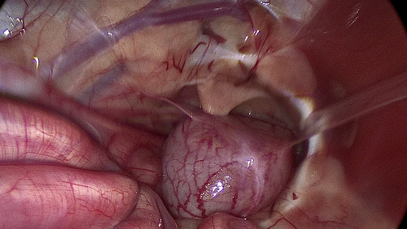 Laparoscopic view of the urinary bladder during minimally invasive surgery