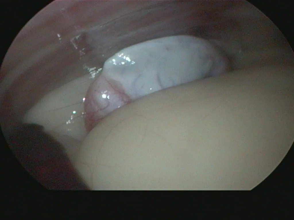 Cryptorchid (undescended) testicle located through laparoscopy