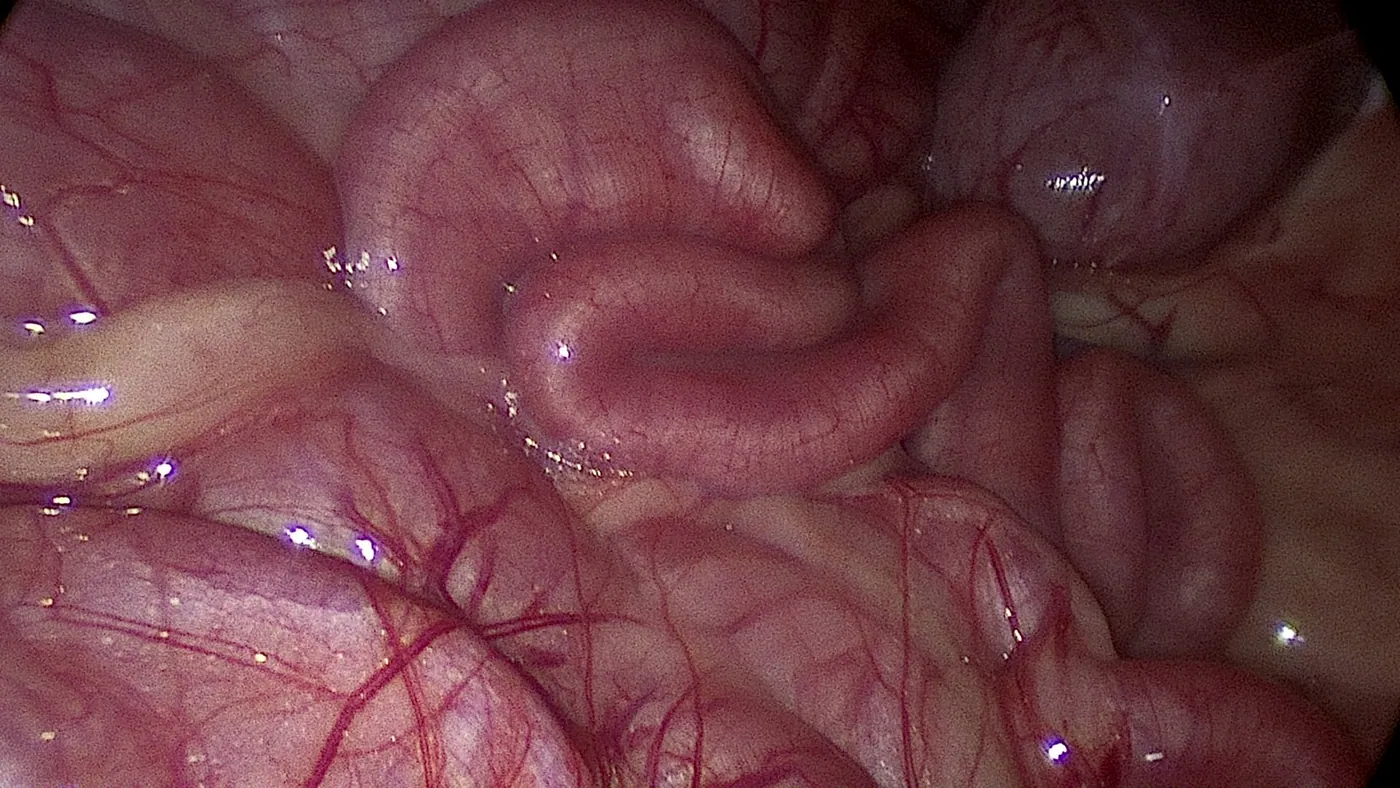 Laparoscopic view of small intestines and bladder during exploratory surgery