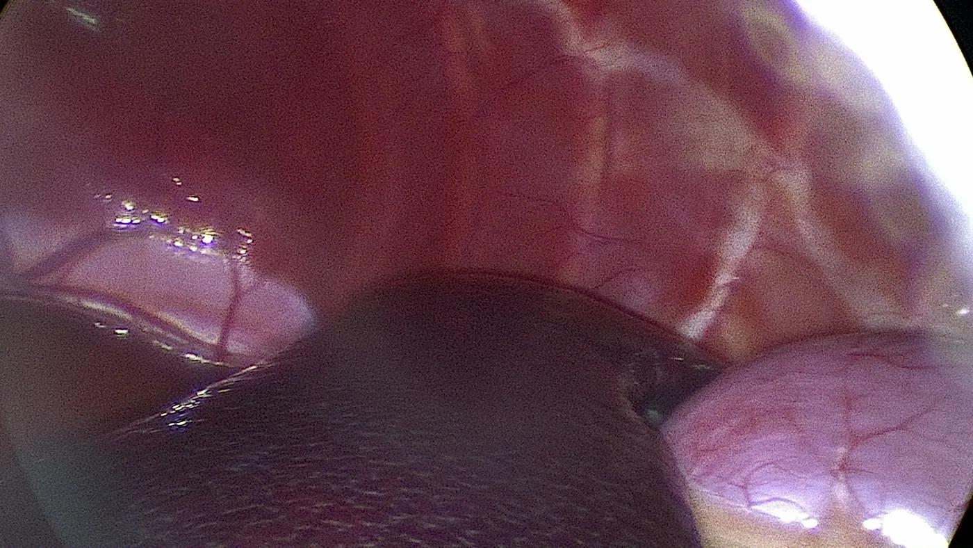 Laparoscopic view of spleen and kidney during abdominal exploration