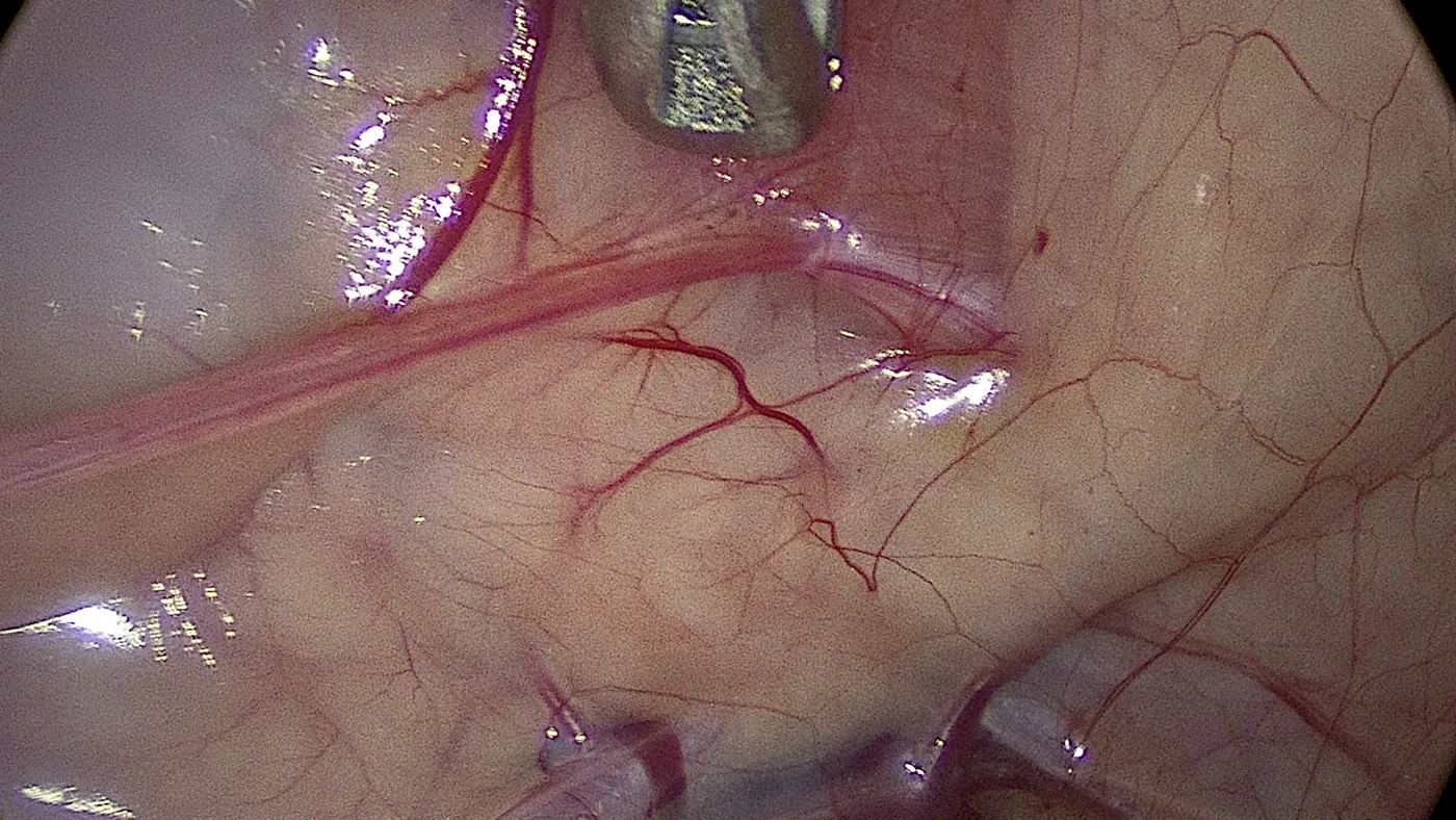 Laparoscopic identification of the ureter during minimally invasive surgery