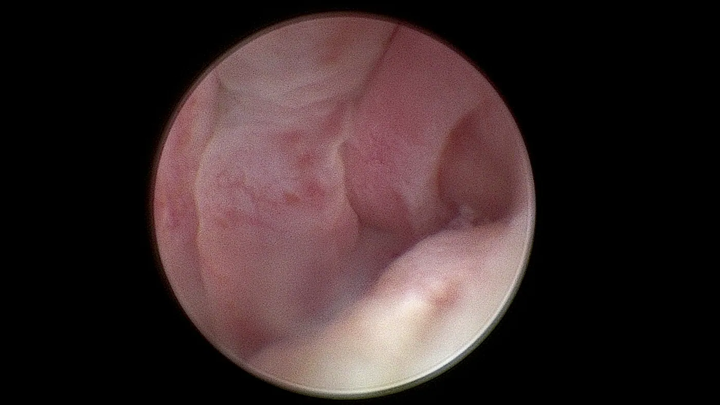 Endoscopic view of nasal cavity during laser-assisted rhinoscopy