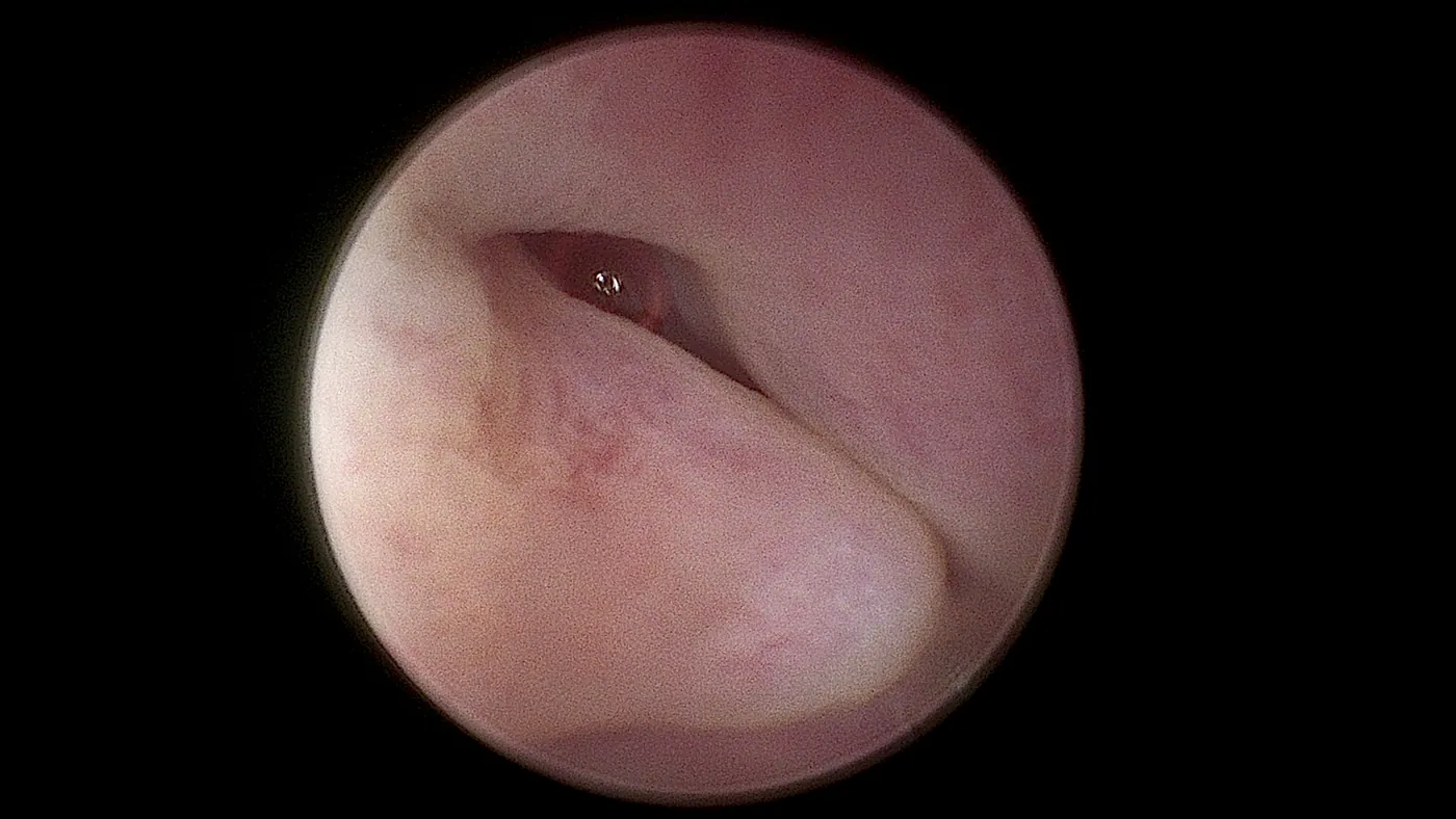 Rhinoscopy procedure used to guide laser ablation of nasal disease