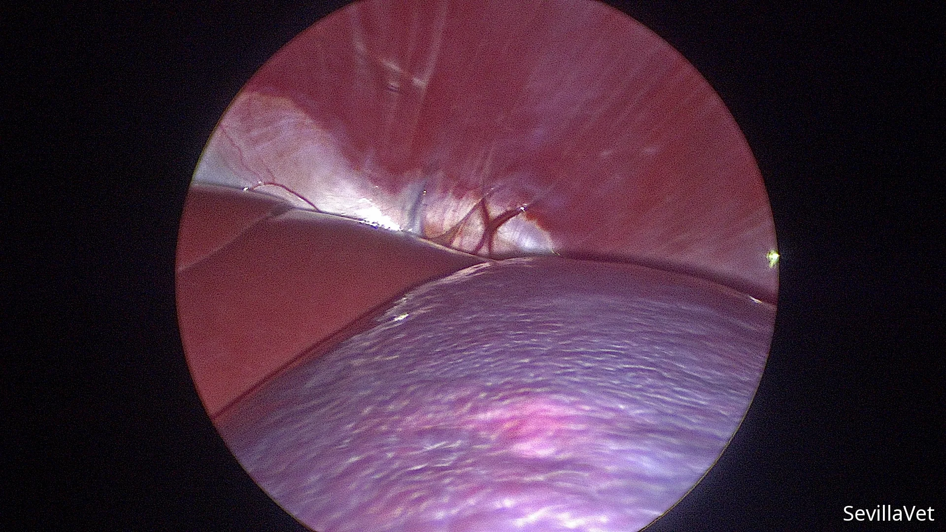 Laparoscopic view of the liver and spleen during minimally invasive surgery