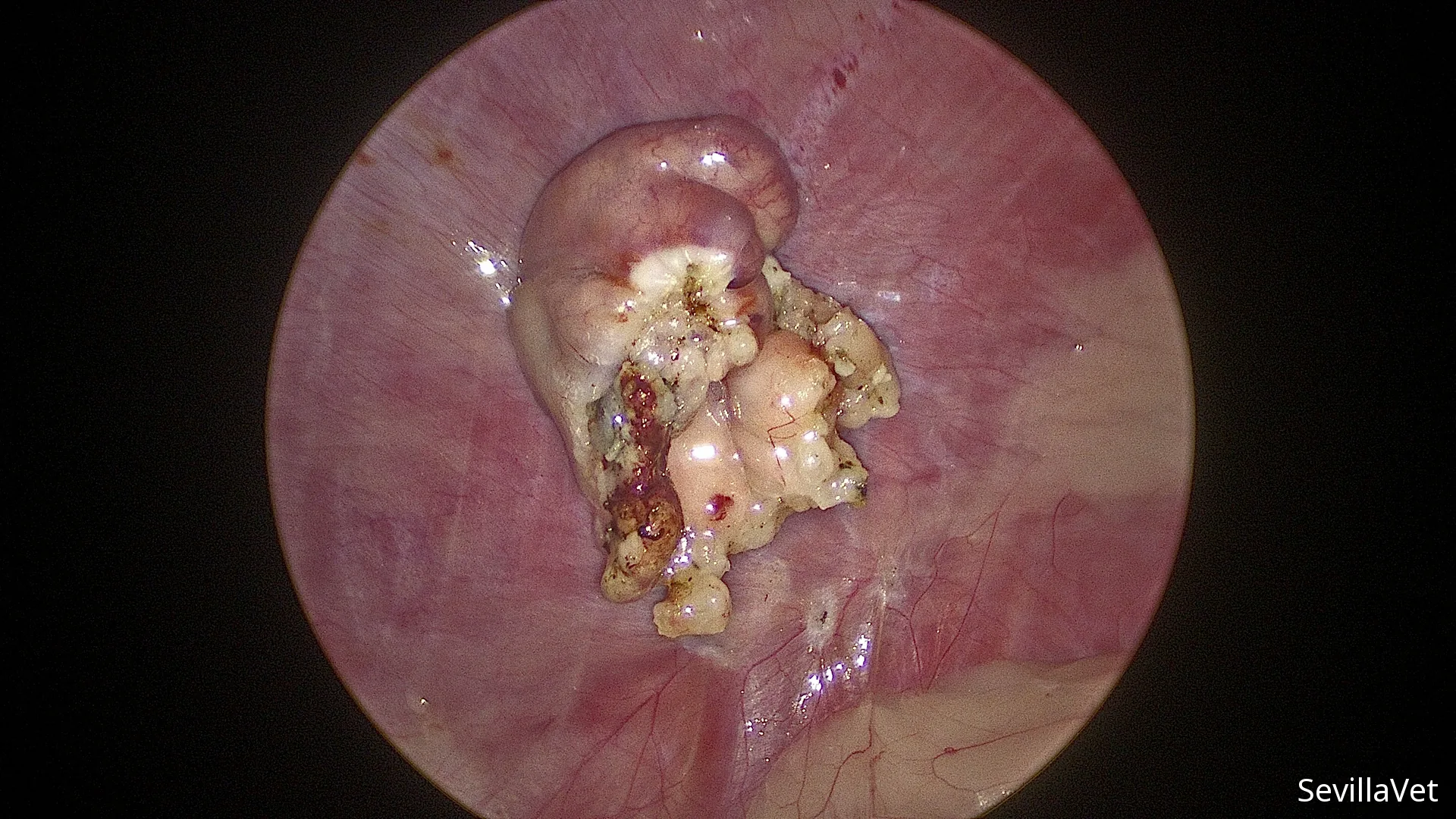 Laparoscopic view after sealing and dividing the ovarian blood supply