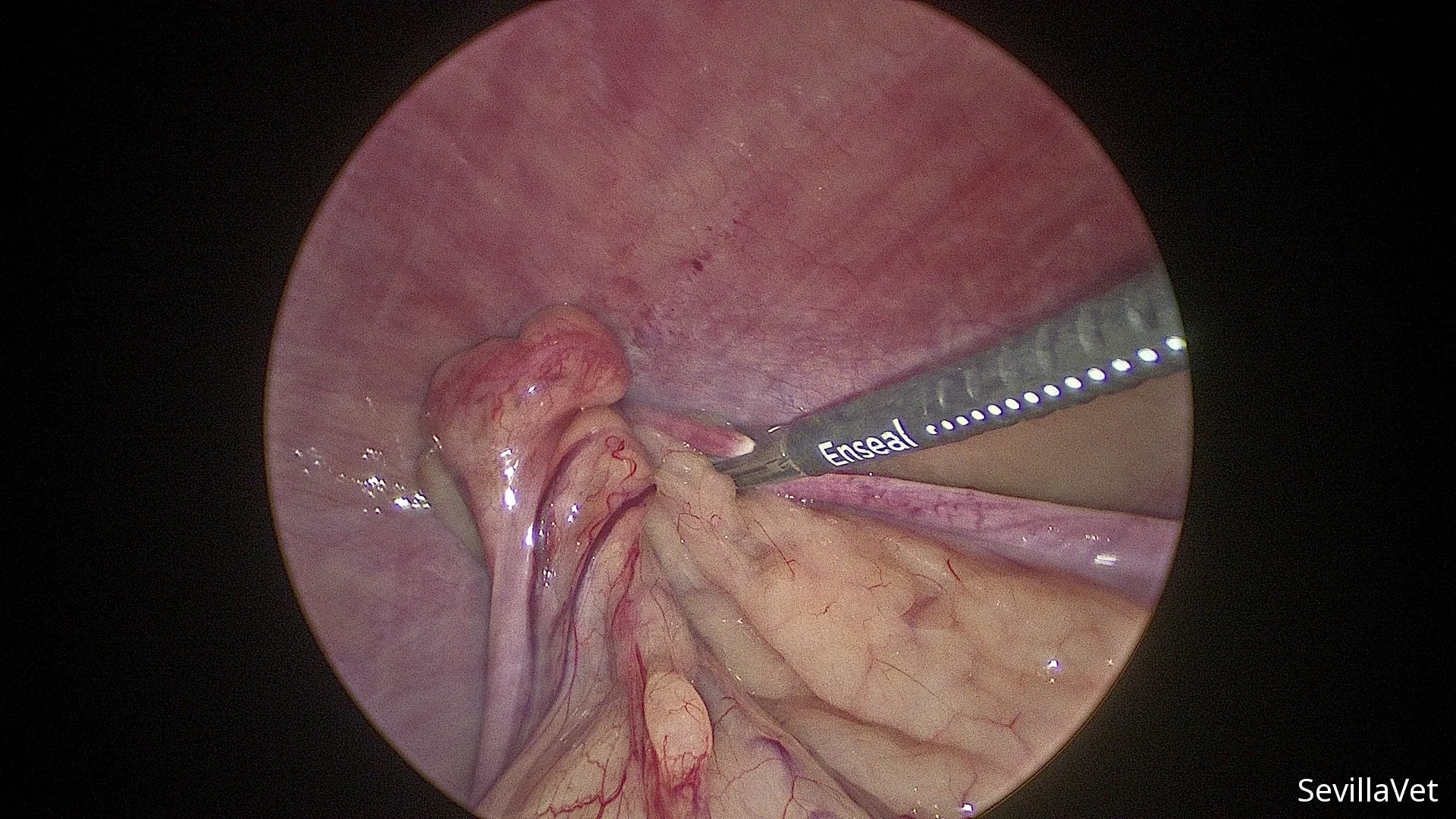 Laparoscopic vessel sealing of the ovarian blood supply