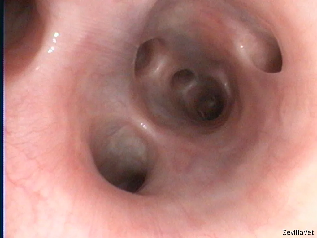 Thoracoscopic view of the right lung during minimally invasive chest surgery